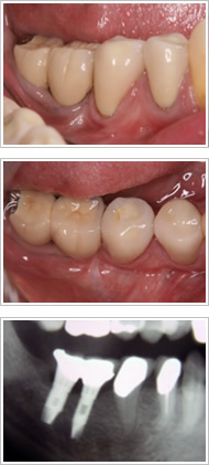 歯周外科処置（歯肉そうは術）治療後2