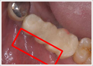 歯周外科処置（歯肉増大術）治療前