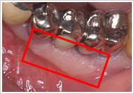 歯周外科処置（歯肉増大術）治療後1
