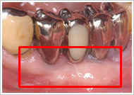 歯周外科処置（歯肉増大術）治療後2