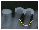 歯周外科処置（骨再生療法術）治療前1